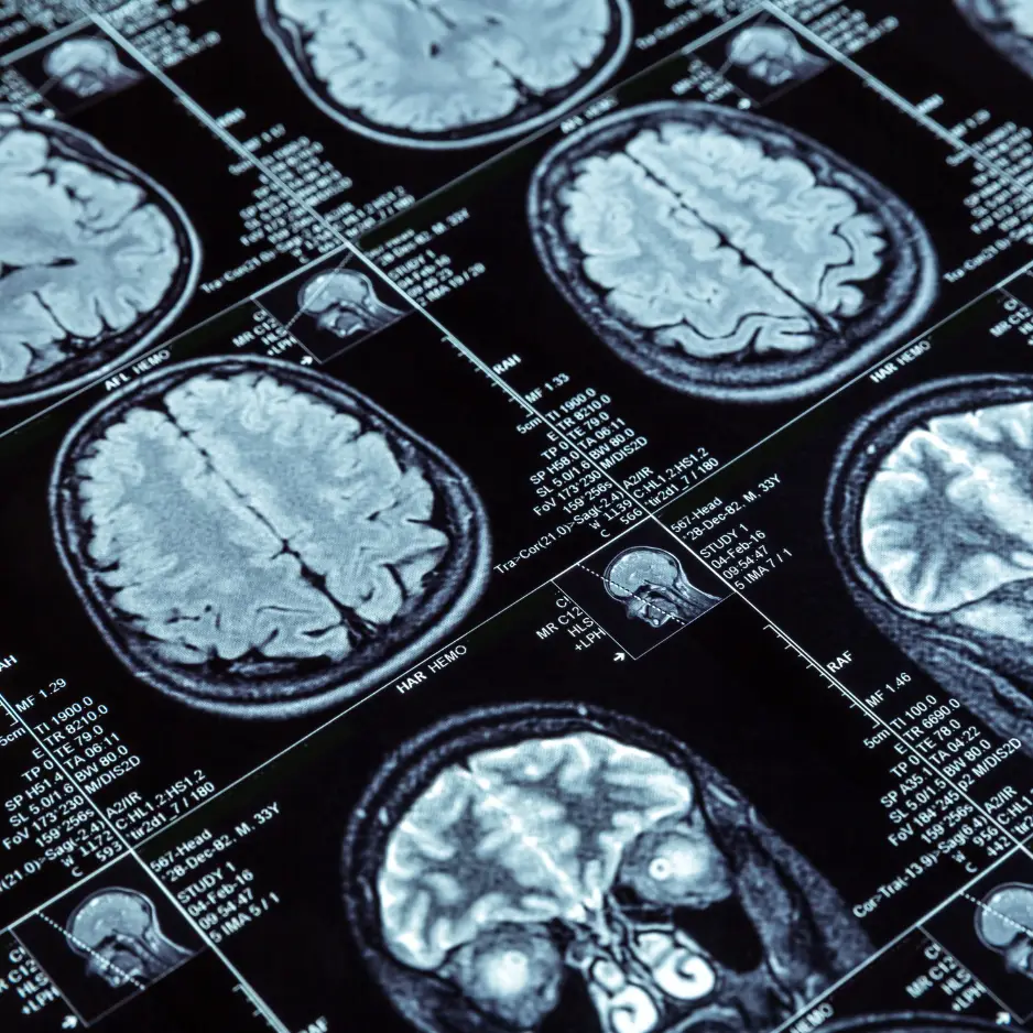 Estudios de resonancia magnética de cerebro